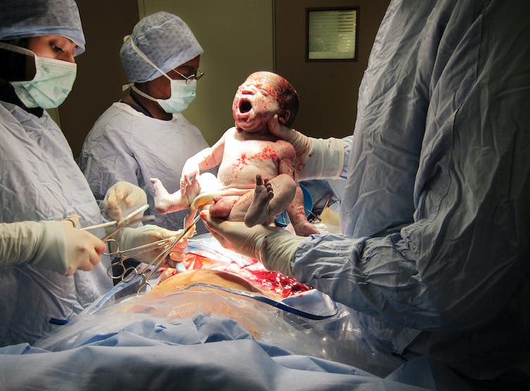 three masked medical workers hold newborn above mother's body during C-section operation