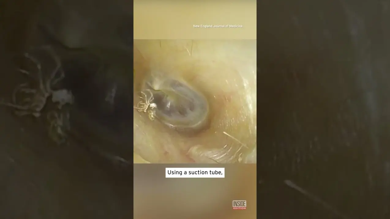 Video Thumbnail: Spider Lives in Woman’s Ear Canal for 4 Days #shorts
