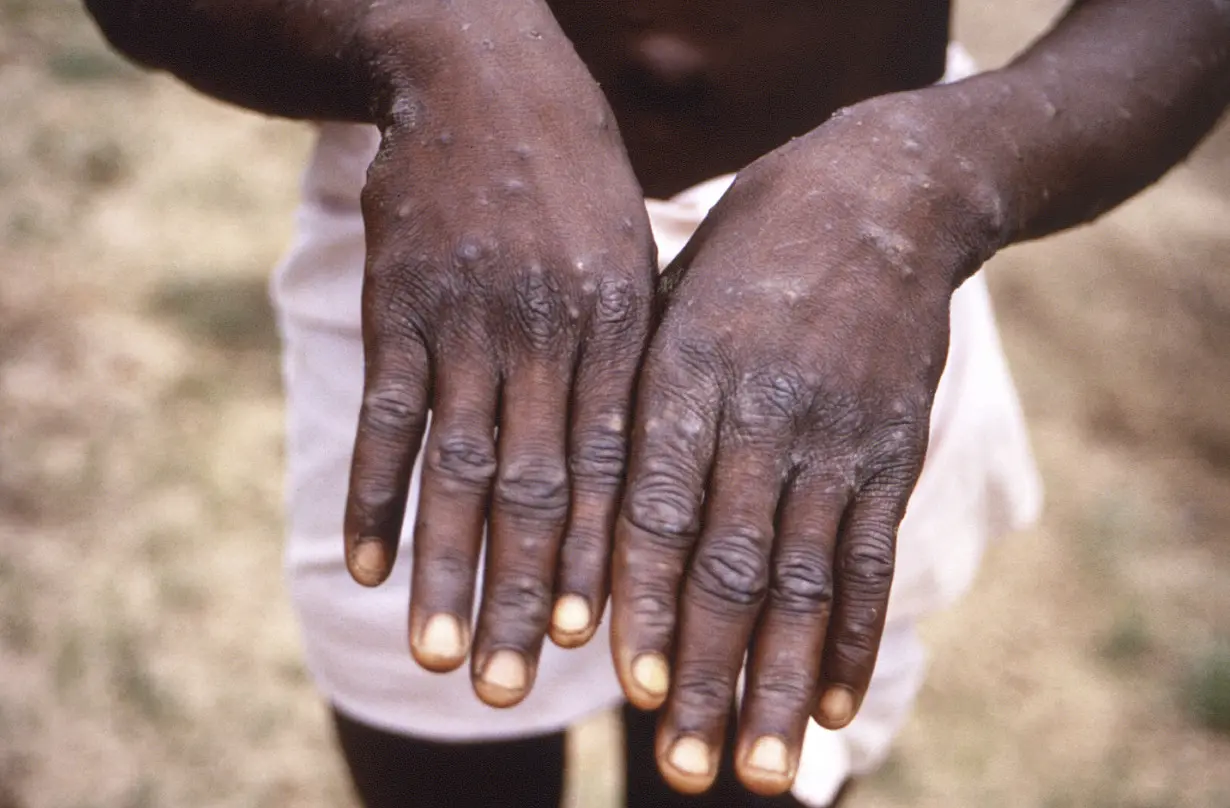 Congo Mpox