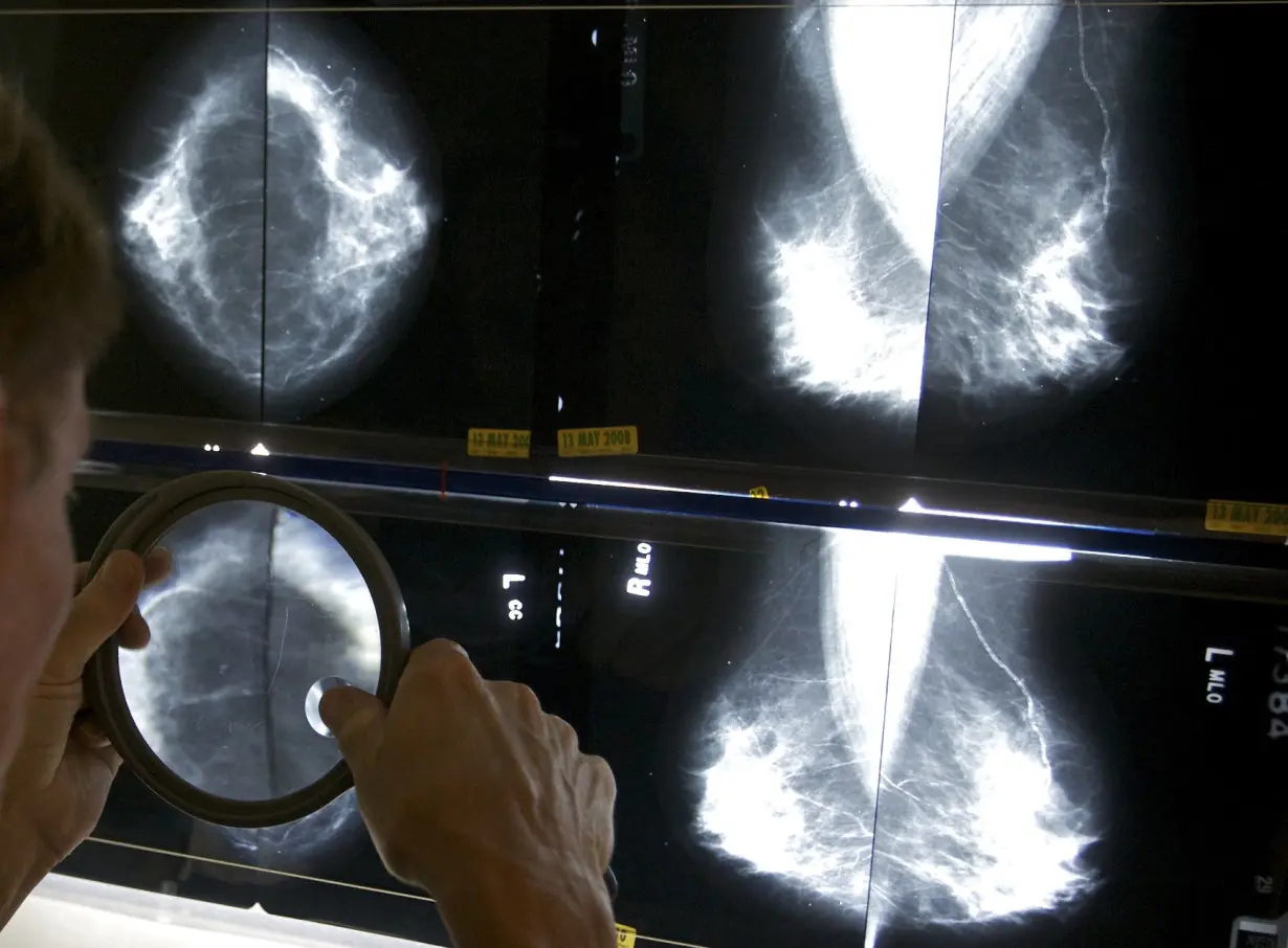 Mammograms After Cancer