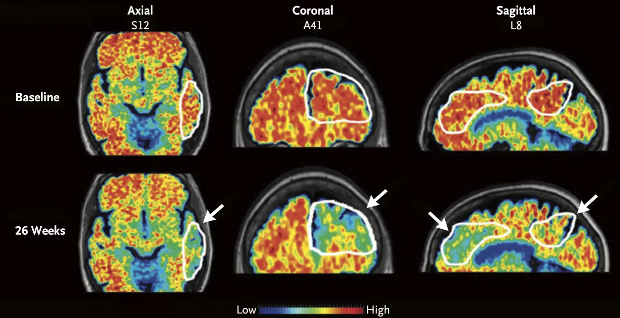 Alzheimer's Brain Drugs