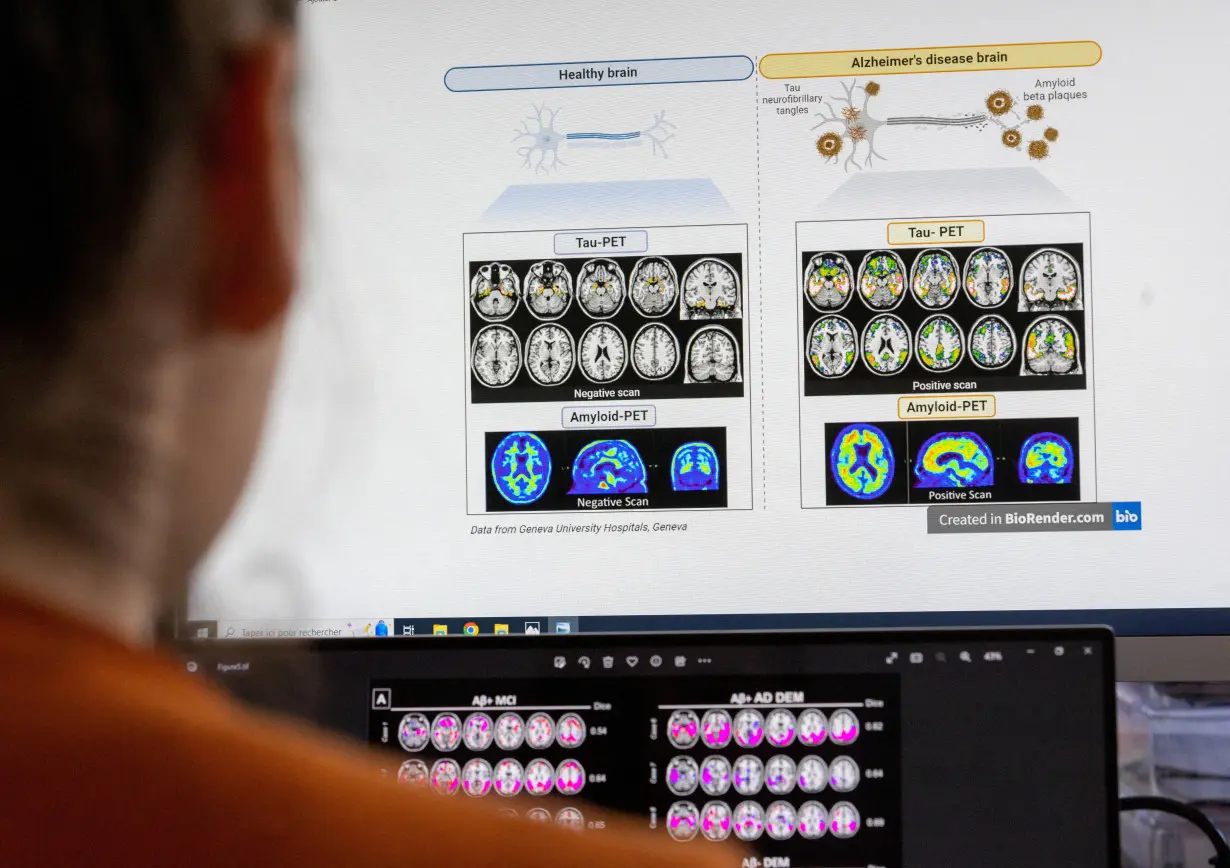 FILE PHOTO: A scientist looks at scans of brains at the Memory Centre at the Department of Readaptation and Geriatrics of the University Hospital (HUG) in Geneva