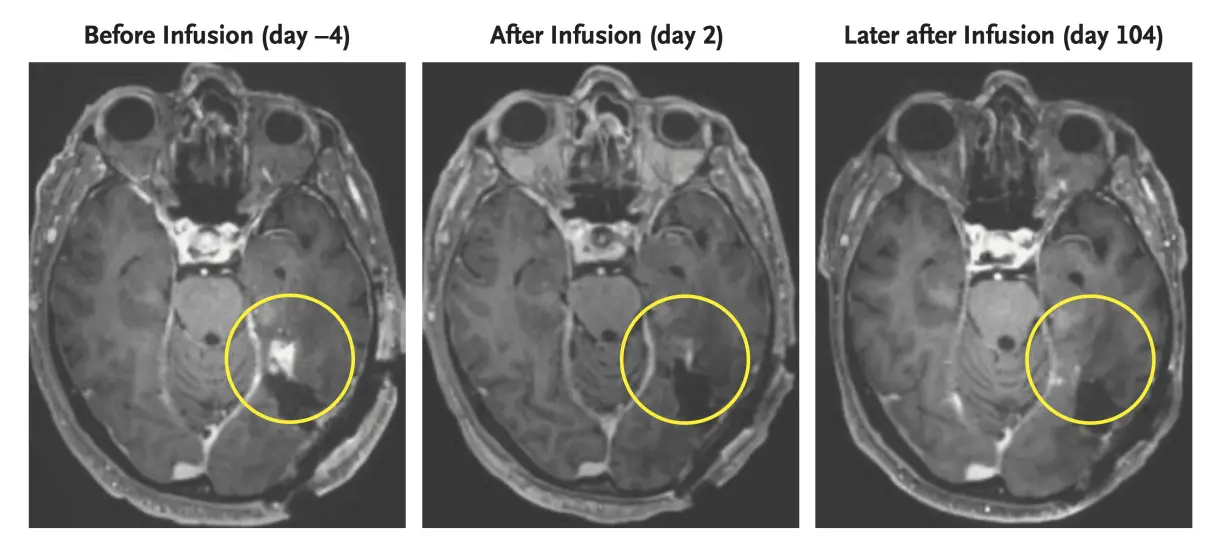 Brain Tumors