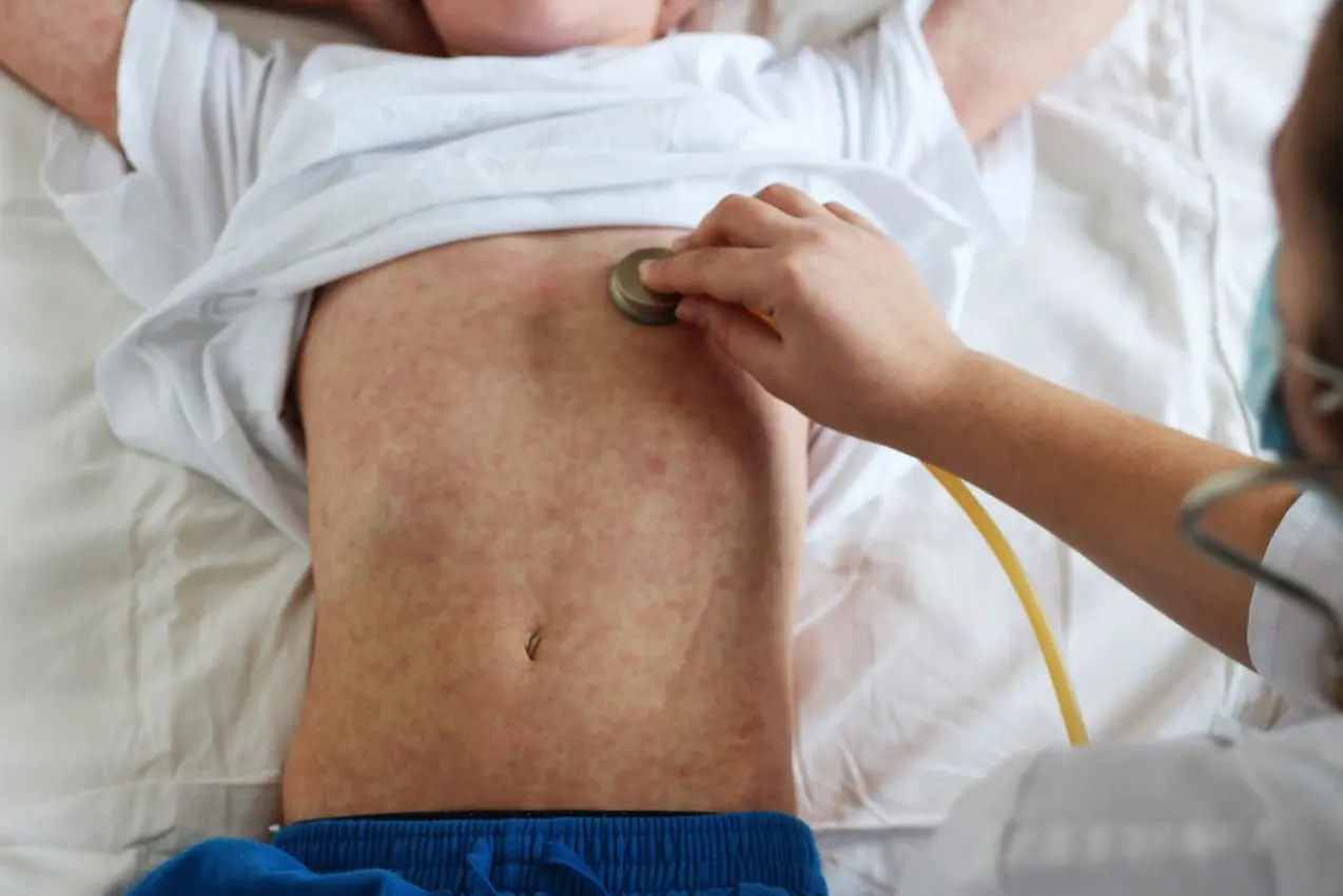 Measles Outbreak