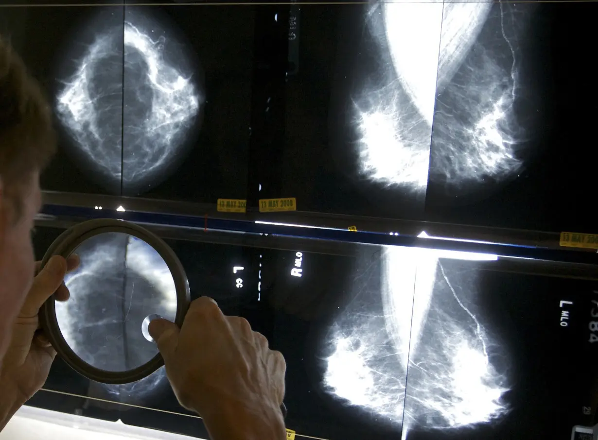 LA Post: Mammograms should start at 40 to address rising breast cancer rates at younger ages, panel says
