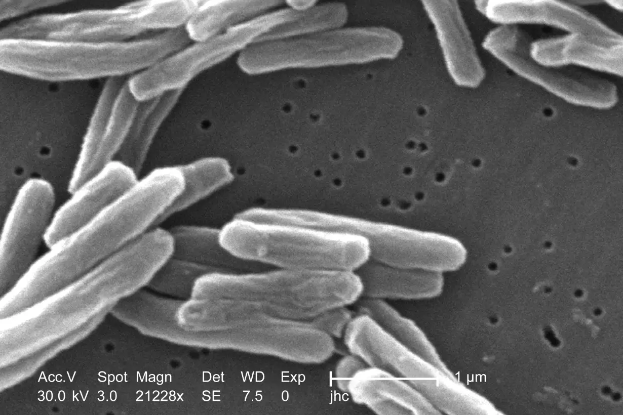 LA Post: US tuberculosis cases were at their the highest level in a decade in 2023