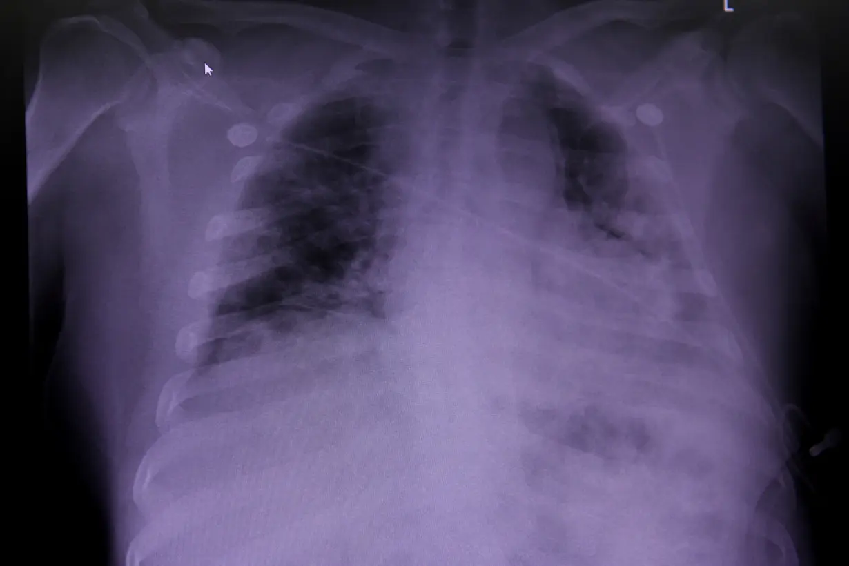 FILE PHOTO: An X-ray of a COVID-19 patient's lungs in Houston, Texas