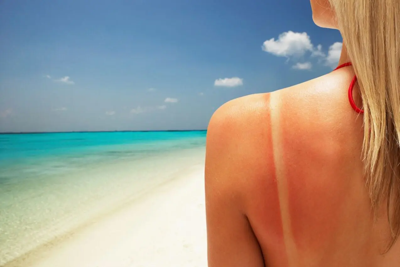 Beat the burn: Dermatologists' top tips for treating sunburns