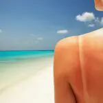 How can you survive sunburns? Experts reveal best treatments for California's rays