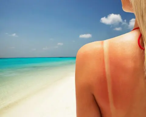 Beat the burn: Dermatologists' top tips for treating sunburns
