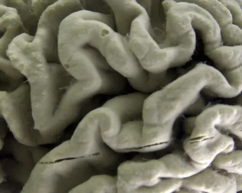 A gene long thought to just raise the risk for Alzheimer's may cause some cases