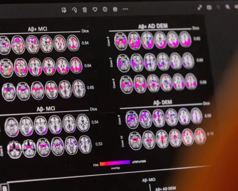 People with two copies of a risk gene have genetic form of Alzheimer's, scientists say
