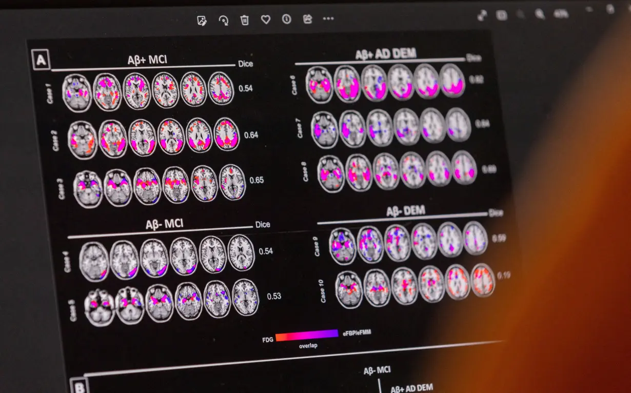 FILE PHOTO: A scientist looks at hypometabolic and hypoperfusion patterns at the single-subject level from a patient suffering from Alzheimer's disease at the Memory Centre at the Department of Readaptation and Geriatrics of the University Hospital (HUG) i