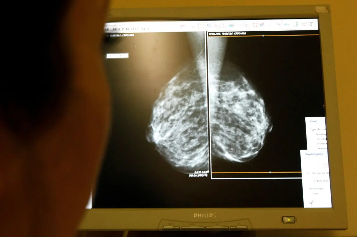 FILE PHOTO: A doctor exams mammograms, a special type of X-ray of the breasts, which is used to detect tumours as part of a regular cancer prevention medical check-up at a clinic in Nice