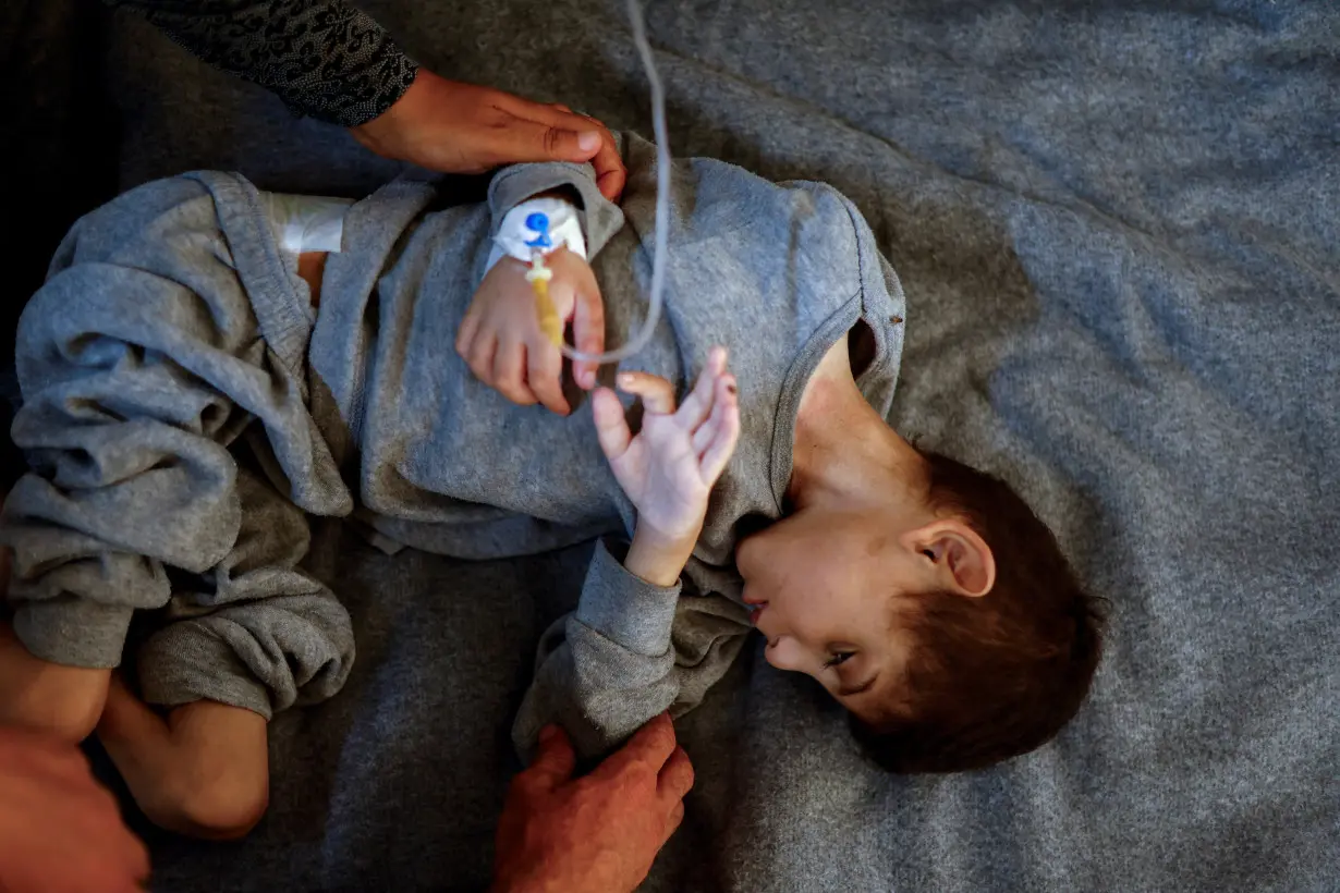 Younis Joma, a malnourished Palestinian boy, receives treatment at at Nasser hospital in Khan Younis, in the southern Gaza Strip