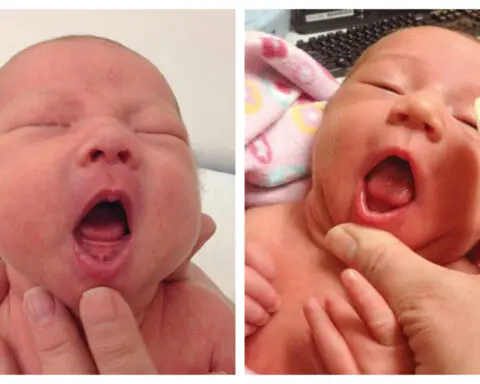 Infants' tongue-tie may be overdiagnosed and needlessly treated, American Academy of Pediatrics says