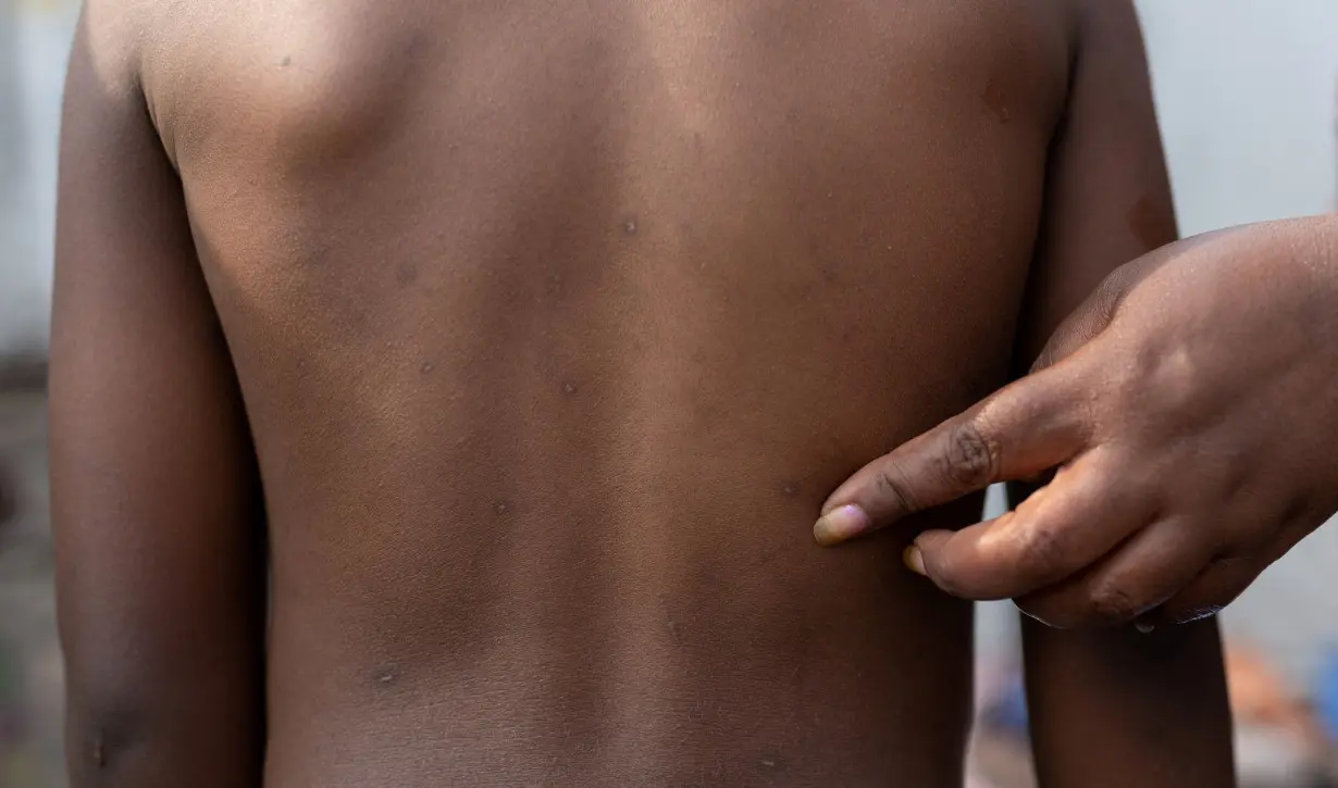 FILE PHOTO: Rash marks on child in Congo, who recovered from mpox