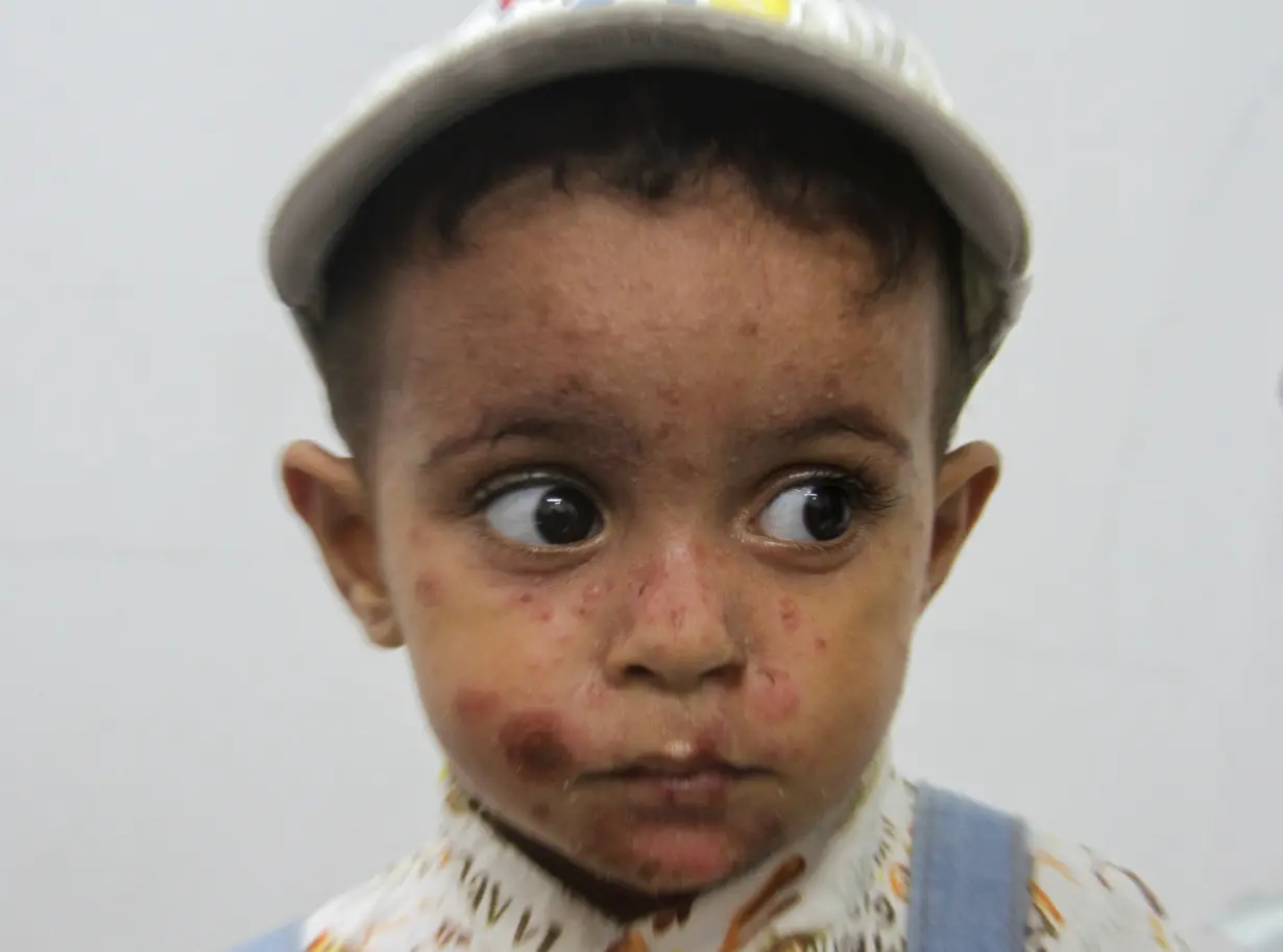 Skin diseases worsen the plight of Gazans as war drags on