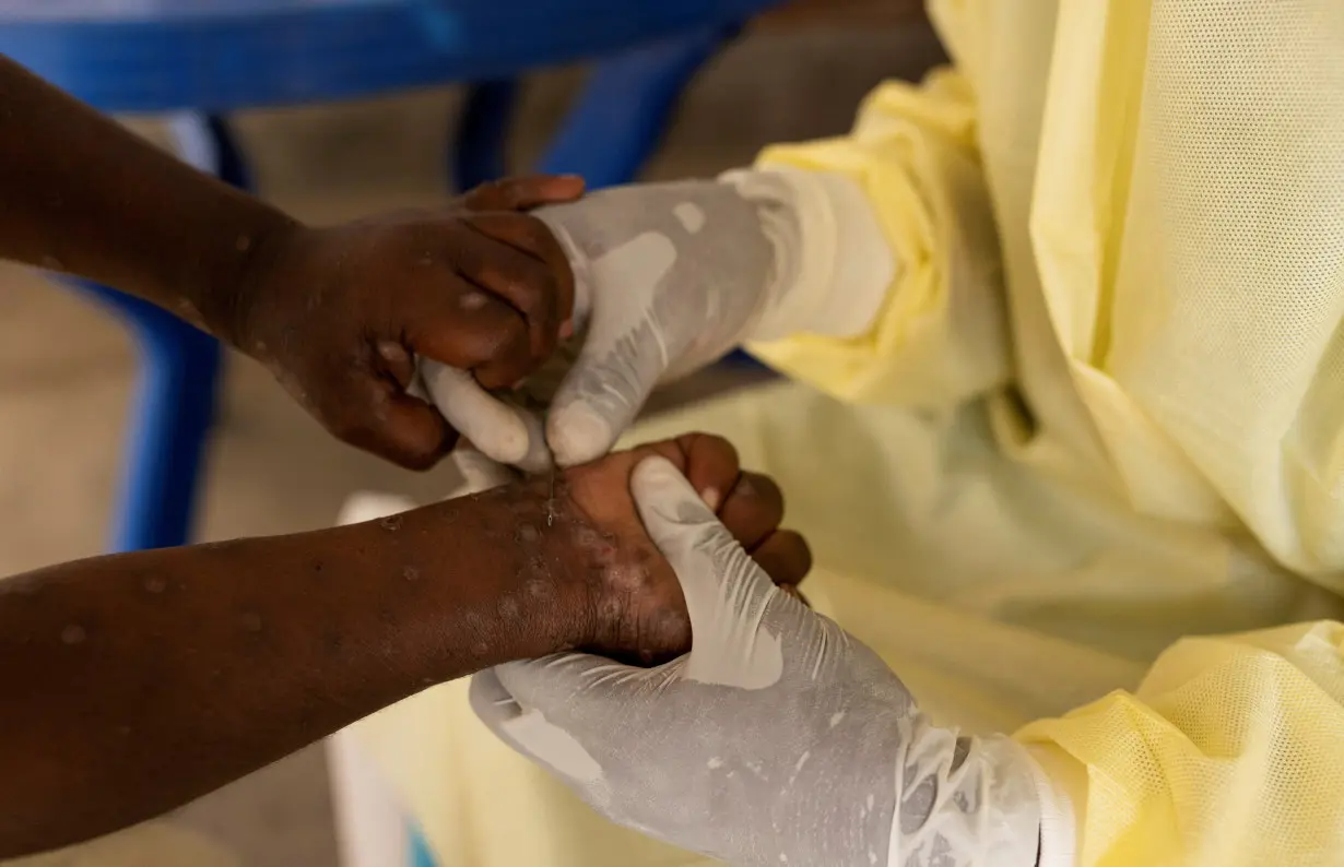 FILE PHOTO: Christian Musema, a laboratory nurse, takes a sample from a child declared a suspected case of Mpox