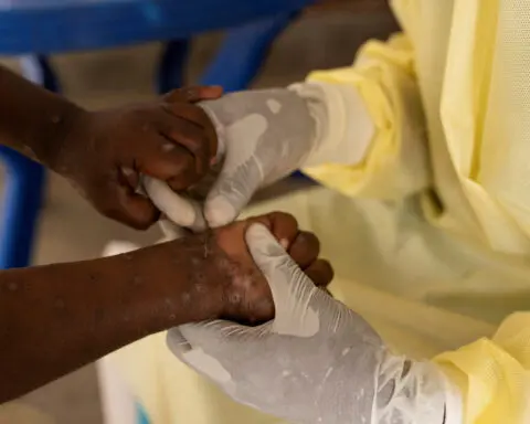 Congo hopes to receive first mpox vaccines by next week