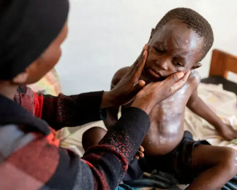 Africa's mpox response is less than 10% funded, says Africa CDC