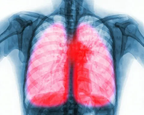 Long COVID inflicts deep scars on the lungs, but targeting specific immune cells could reverse damage − new research in mice