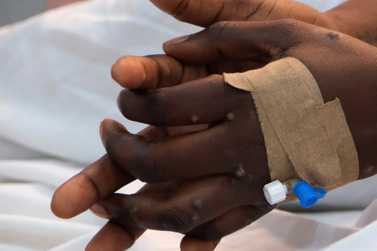 The hands of a patient with skin rashes caused by the mpox virus are pictured in Kinshasa