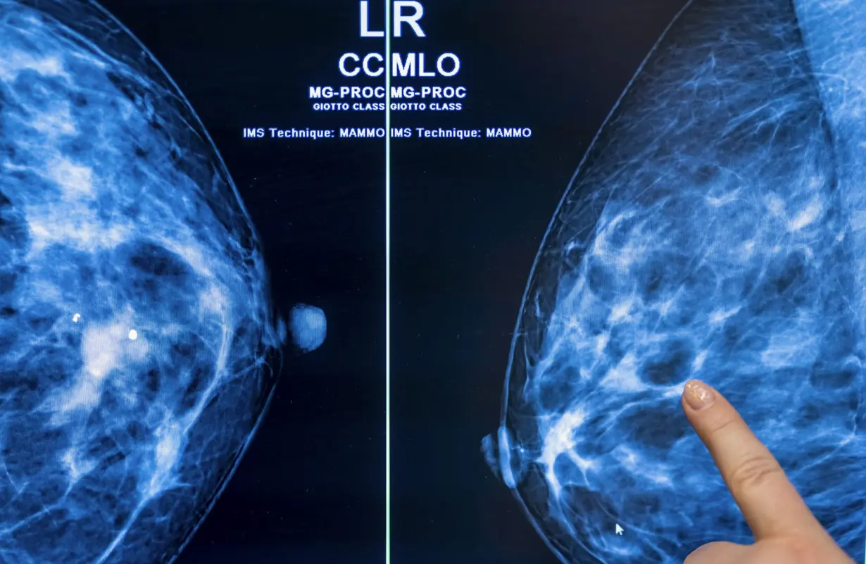 Breast density and mammograms: New FDA rule will ensure all women have more information after cancer screenings