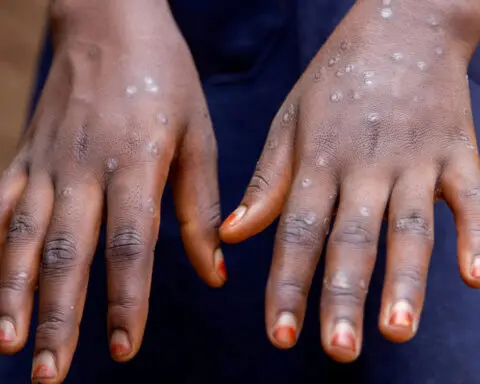 Fighting mpox stigma key to ending Burundi outbreak quickly, UNICEF says