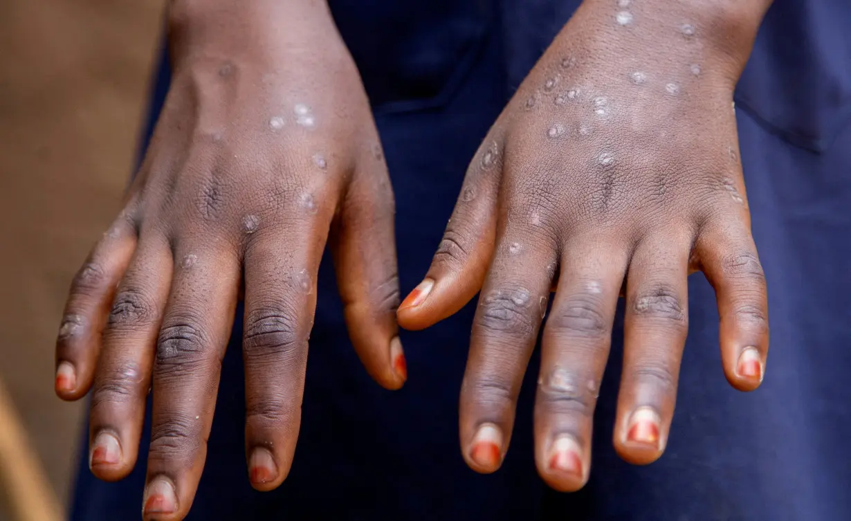 FILE PHOTO: Mpox survivors return home after recovering in Kinama zone, in Bujumbura