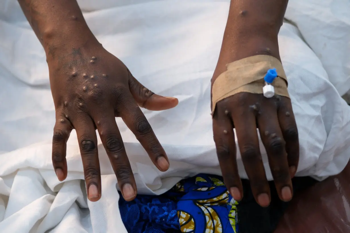 The hands of a patient with skin rashes caused by the mpox virus are pictured in Kinshasa