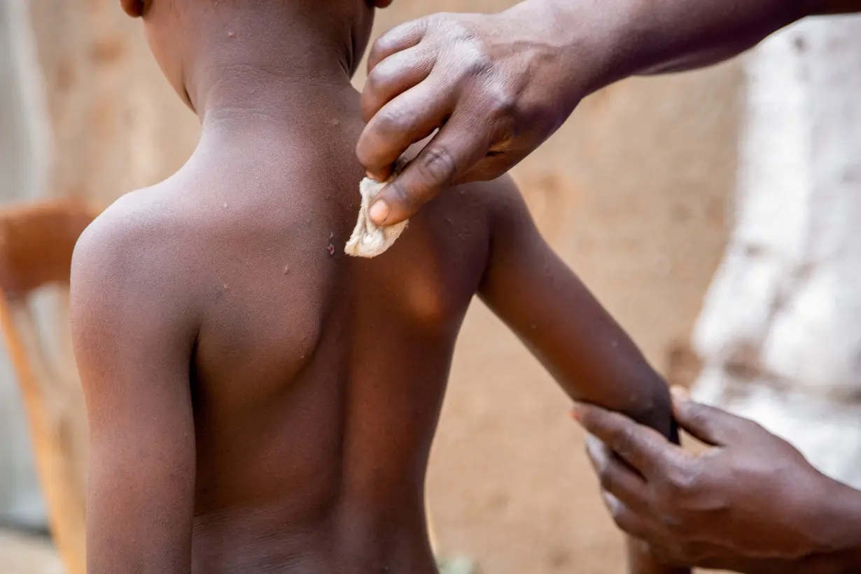 FILE PHOTO: Mpox survivors return home after recovering in Kinama zone, in Bujumbura