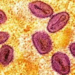 Zimbabwe reports first two mpox cases of unspecified variant