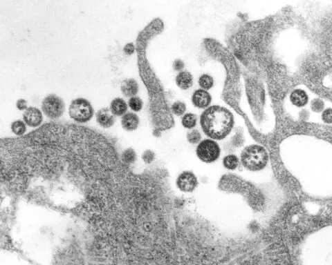 Iowa resident dies of rare Lassa fever, officials say