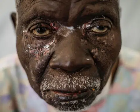 Mpox cases in Congo may be stabilizing. Experts say more vaccines are needed to stamp out virus