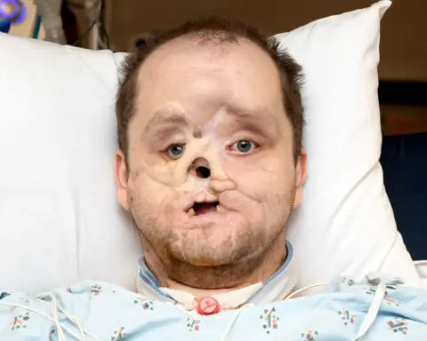 'I look like a person again': Michigan man shares story after face transplant