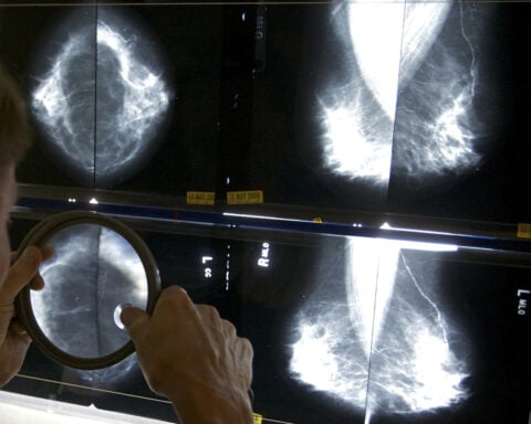 Some breast cancer patients can avoid certain surgeries, studies suggest