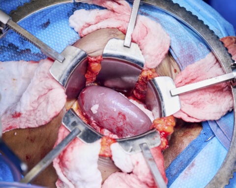 An Alabama woman is doing well after the latest experimental pig kidney transplant