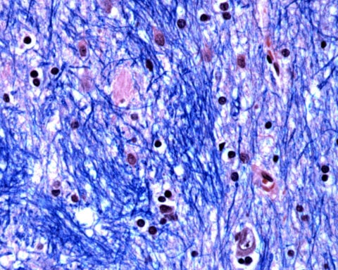 Surprise finding sheds light on what causes Huntington's disease, a devastating fatal brain disorder