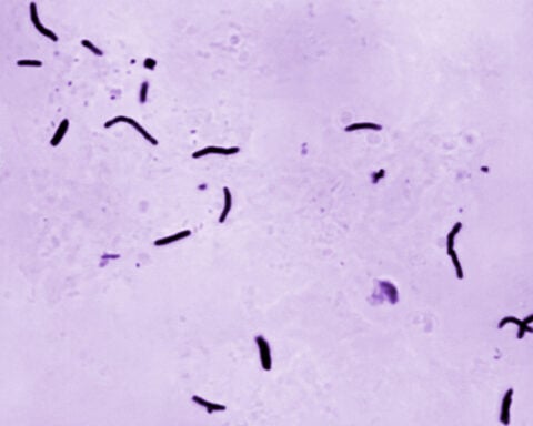 The tuberculosis outbreak in Kansas is alarming. It's not the biggest in US history though, CDC says