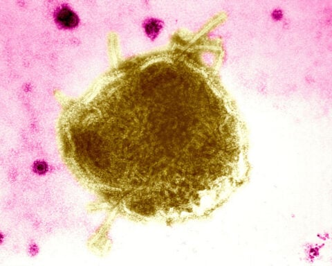 Gupta explains the challenges doctors face in preventing measles outbreak