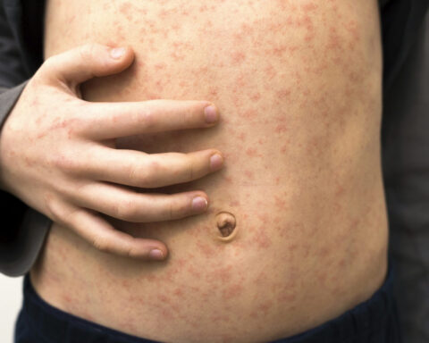 Texas records first US measles death in 10 years – a medical epidemiologist explains how to protect yourself and your community from this deadly, preventable disease