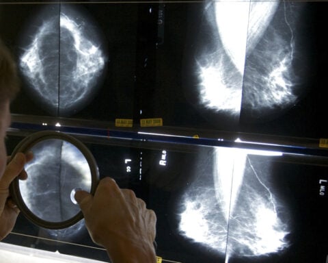 Cancer before age 50 is increasing. A new study looks at which types