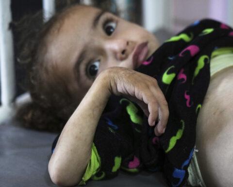 Gaza's main hospital is overwhelmed with children in pain from malnutrition