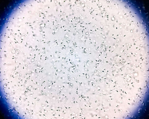 Sperm donor with rare genetic mutation fathered 67 children. Ten now have cancer, prompting calls for reform