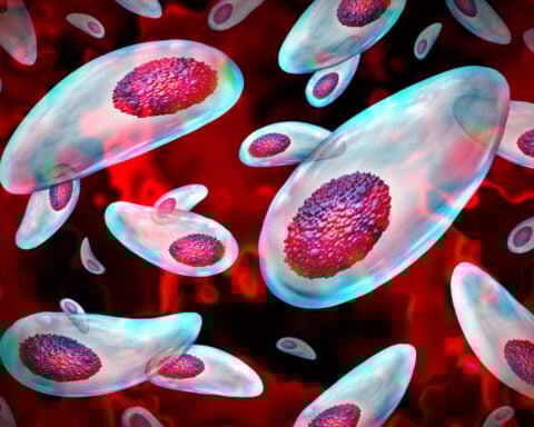 A common parasite can decapitate human sperm − with implications for male fertility