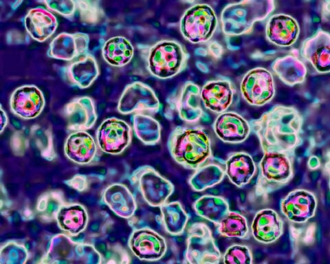 Wastewater is now helping track measles spread around the US