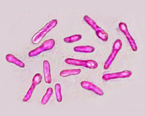 Dozens in northeast England report symptoms of potentially deadly botulism after getting Botox