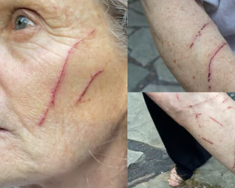 'It was monstrous': Woman attacked by raccoon while letting dogs out for walk