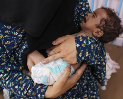 On Gaza malnutrition ward, a child’s arm is as wide as mother’s thumb